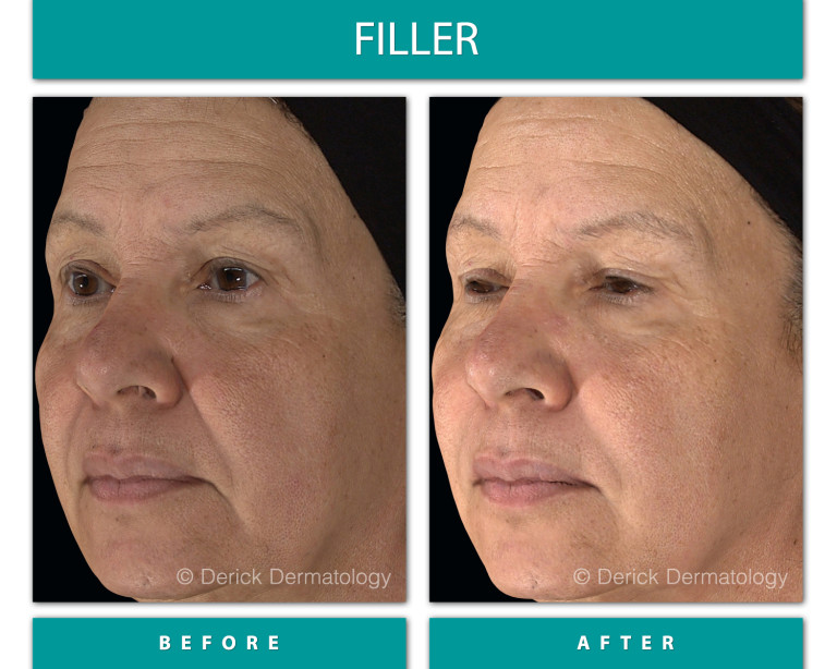 Before and After Image of Filler