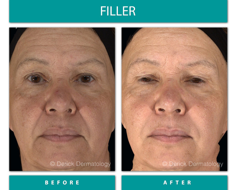 Before and After Image of Filler