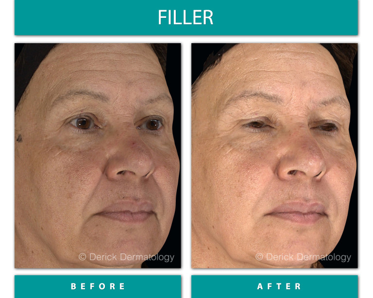 Before and After Image of Filler