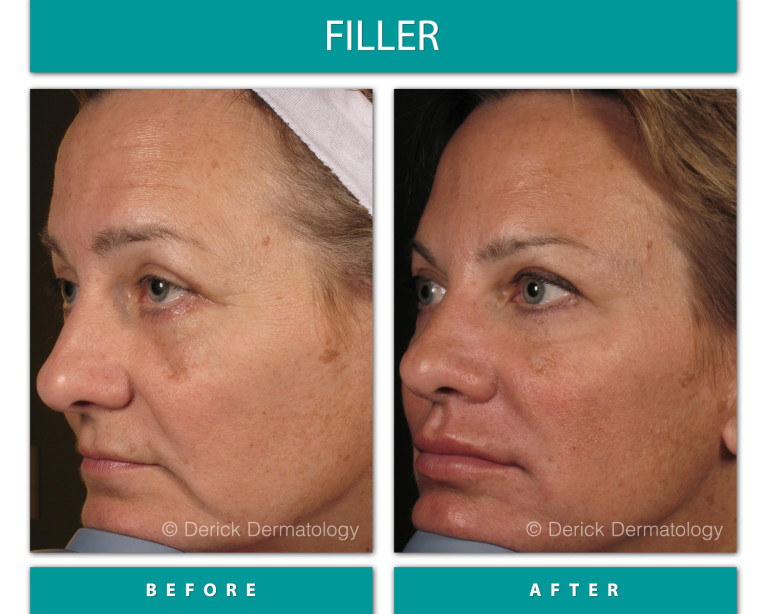 Before & After Gallery - Filler - Derick Dermatology