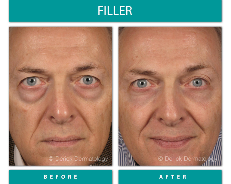 Before and After Image of Filler