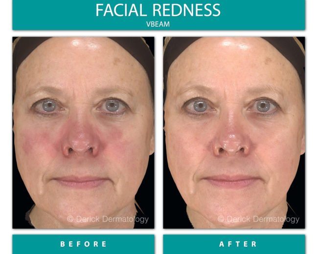 Rosacea and You before and after of woman with rosacea, vbeam treatment