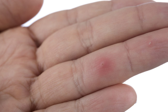 How to Remove a Splinter splinter in finger