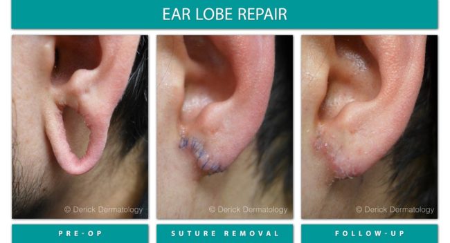 Earlobe Repair stages of earlobe repair. earlobe with hole, earlobe with sutures, earlobe without sutures