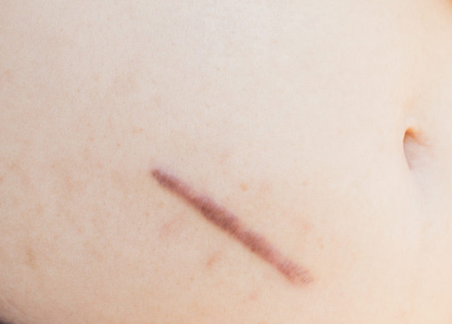 The Facts About Keloids keloid on stomach