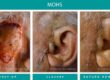 Mohs surgery before and after of cancer removed next to ear