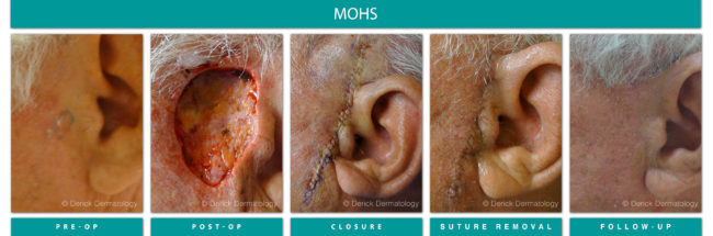 Mohs Surgery Mohs surgery before and after of cancer removed next to ear