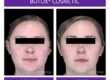 masseter botox before and after of face