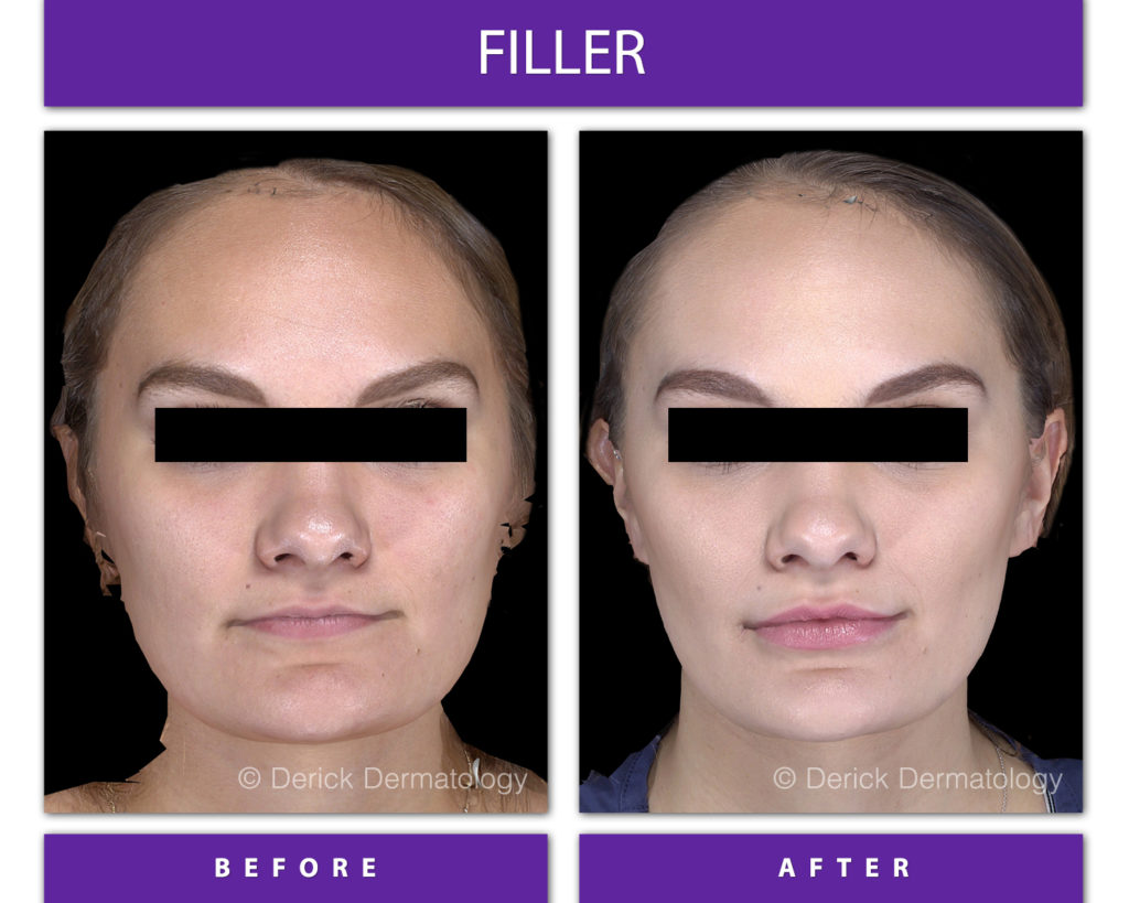 before and after of a woman injected with volbella