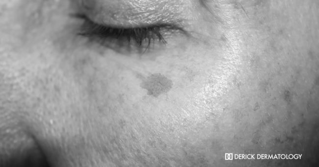 sun-damaged-skin