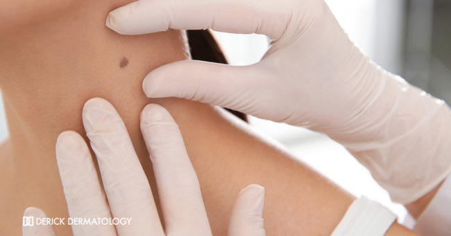 What is a birthmark? What is a birthmark?