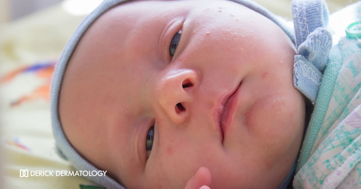 Baby - Chicagoland - Derick Dermatology