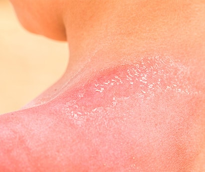 Sun Burnt Skin Damage