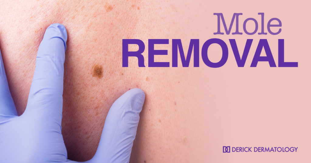 Melanoma And Mole Removal Medical Dermatology Derick Dermatology