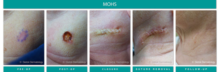 Mohs Surgery Chicago, IL