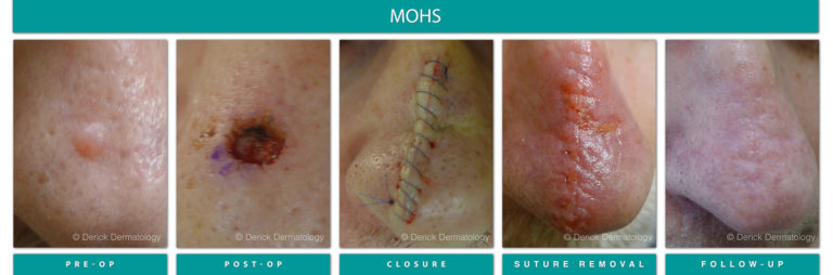 Mohs Surgery Chicago, IL