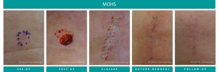 Mohs Surgery Chicago, IL