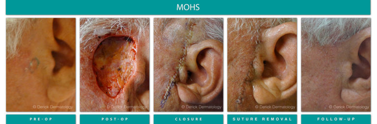 Mohs Surgery Chicago, IL