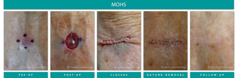 Before & After Gallery - Mohs Surgery - Derick Dermatology