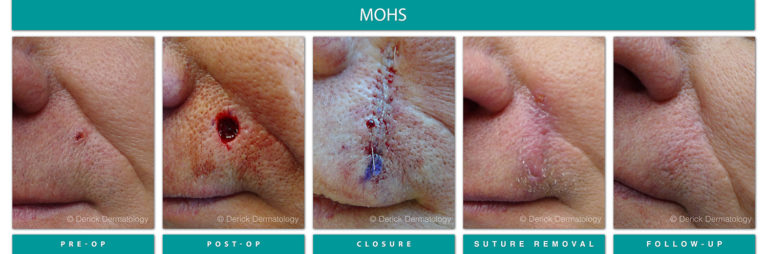 Mohs Surgery Chicago, IL