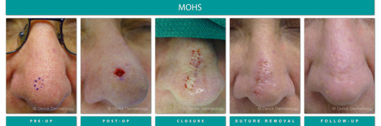 Mohs Surgery Chicago, IL