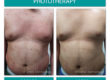 Before & After Phototherapy (NBUVB)