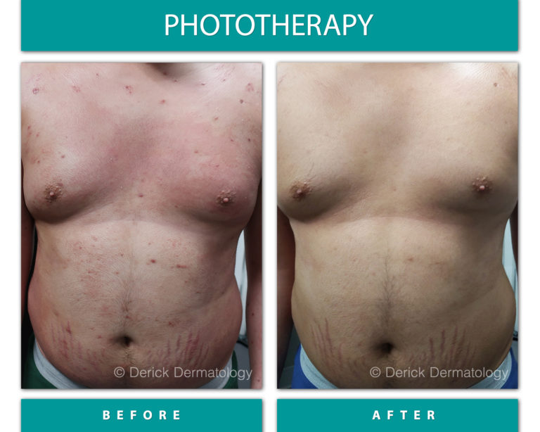 Before & After Phototherapy (NBUVB)