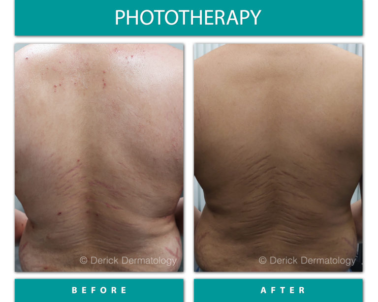 Before & After Phototherapy (NBUVB)
