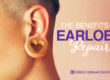 Benefits of Earlobe Repair