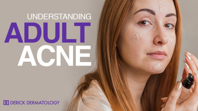 Adult Acne - Derick Dermatology Naperville
