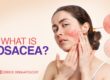 What is Rosacea?