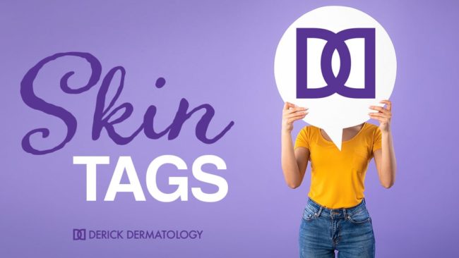 About Skin Tags and How to Treat Them