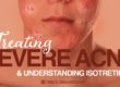 Understanding How Isotretinoin Works