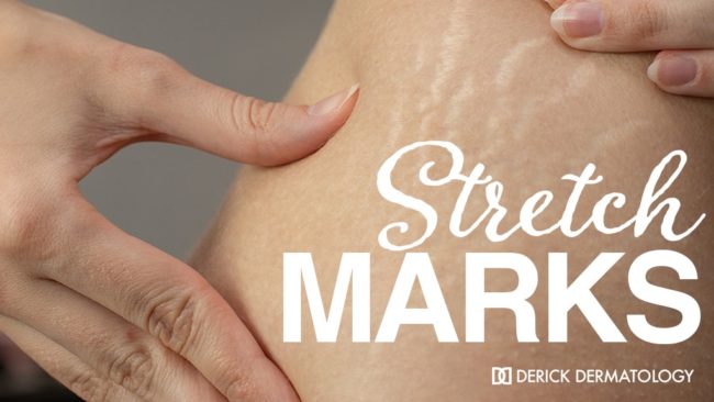 What are stretch marks?