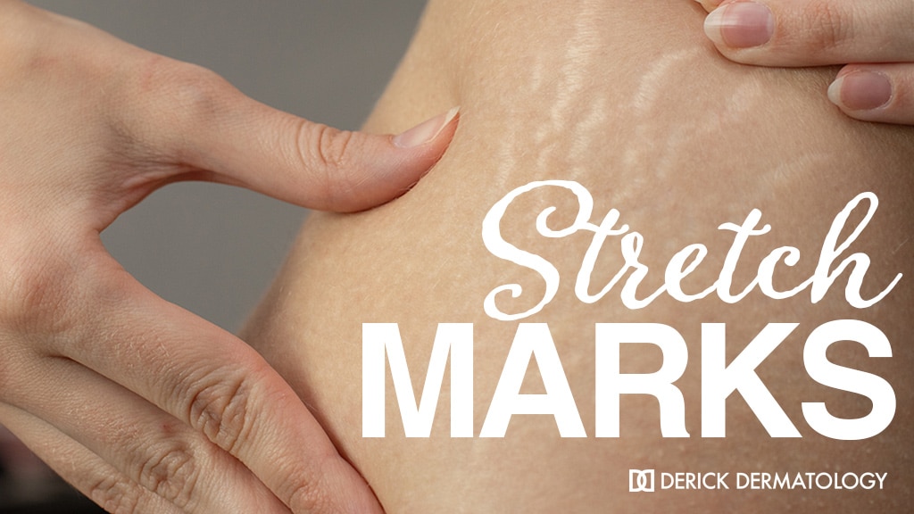How to deal with stretch marks in teenagers, according to a dermatologist