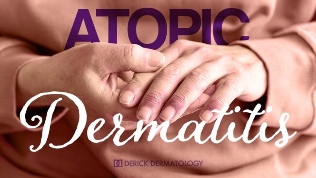 Atopic, Dermatitis, Dermatology, Dermatologist