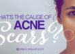 What is the main cause of acne scars?